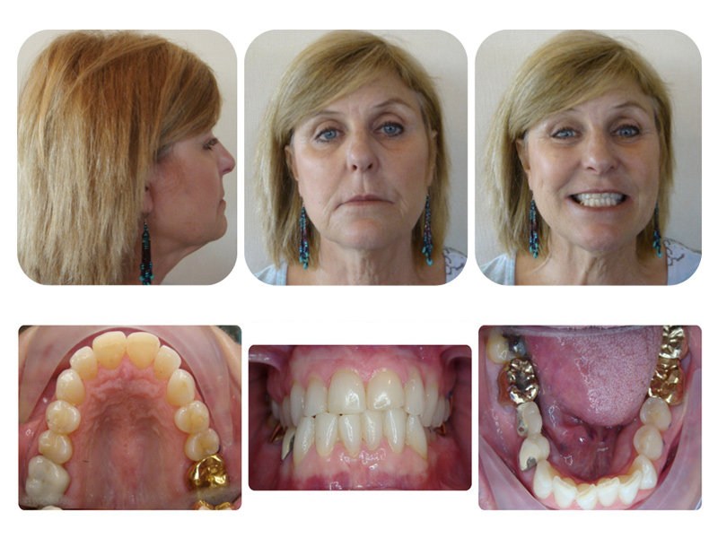 Adult Braces Before And After 82