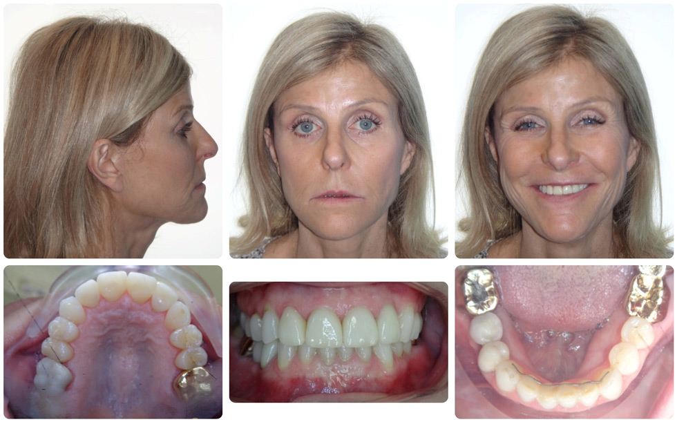 Invisalign Braces For Adults 7