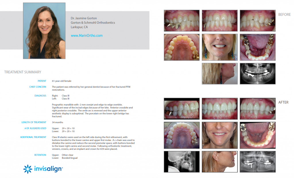Invisalign for Adults Case Study