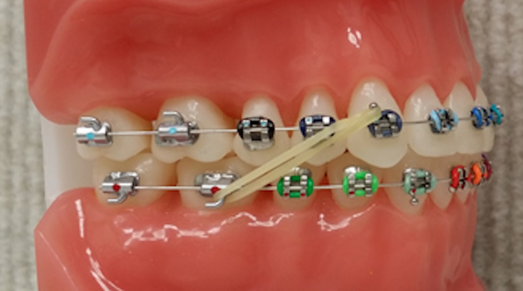 how to put rubber bands on braces