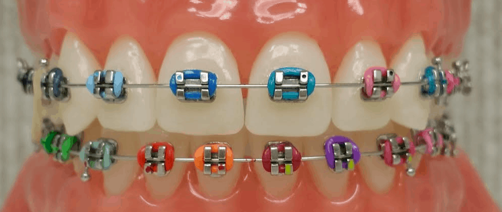 Braces with Colors