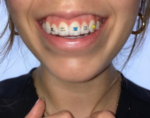 NEW! Invisalign Stickables 2