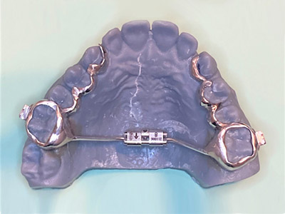 Expander | Traditional and Invisalign 1