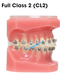 overbite correction rubber bands